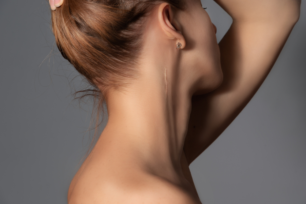 Woman,With,Surgery,Scar,At,Her,Neck.