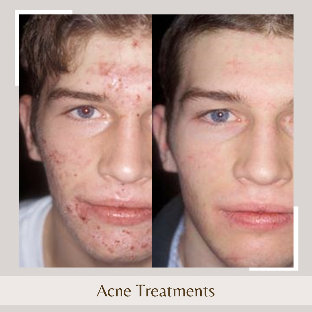 Acne Treatments FACE