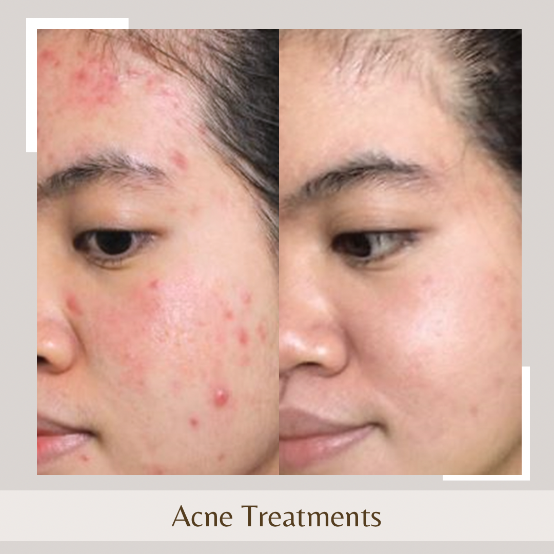 Acne Treatments1 CHEEKS