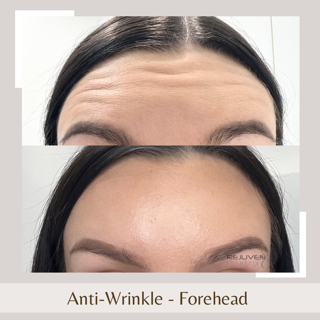 Anti-Wrinkle Forehead