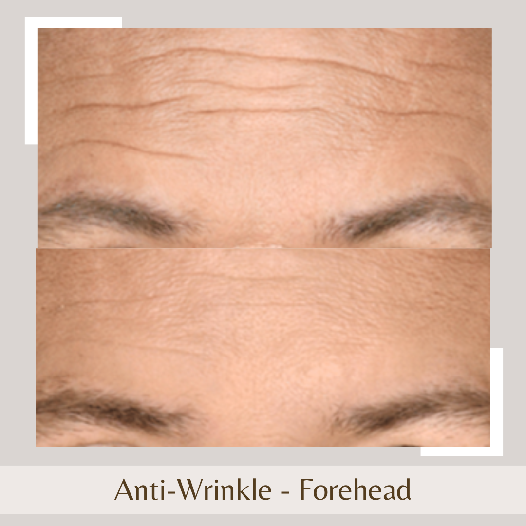 Anti-Wrinkle Forehead1