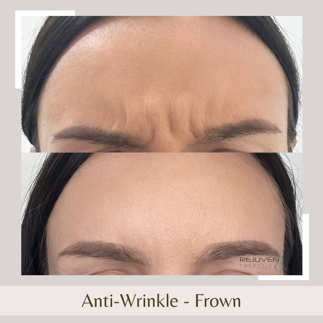Anti-Wrinkle - Frown