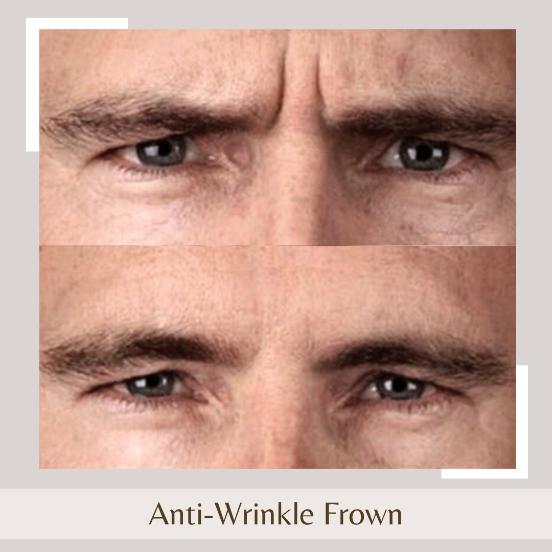 Anti-Wrinkle Frown