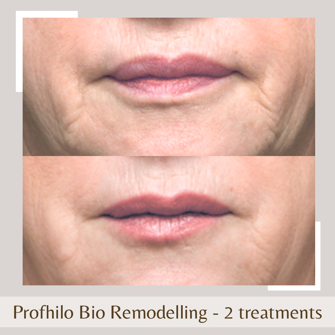 Image of a person before and after Bio-remodelling,