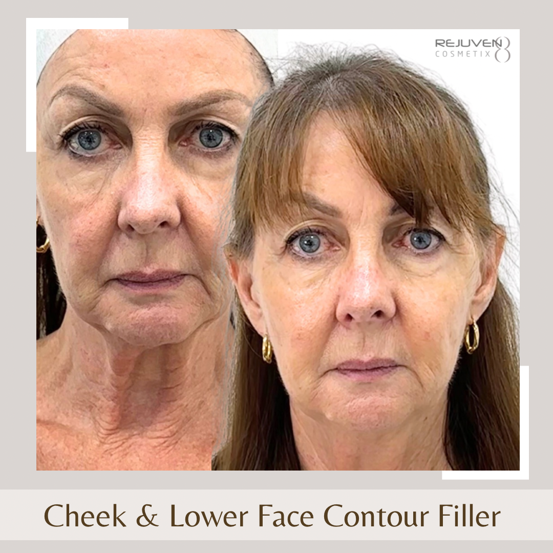 Contour Filler - Cheeks & Lower Face