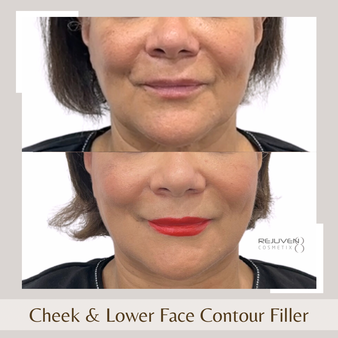 Contour Filler - Cheeks & Lower Face1
