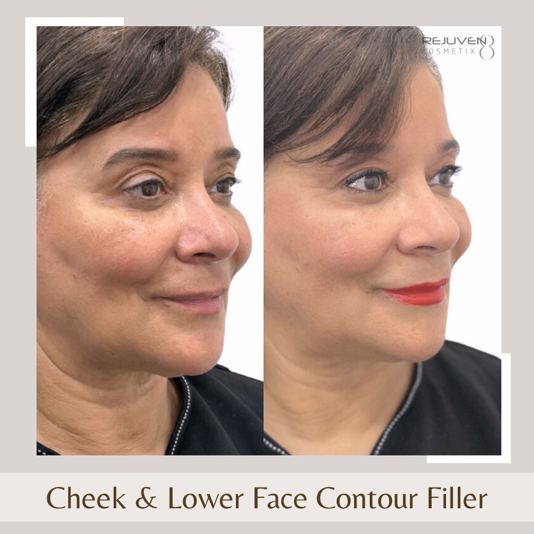 Facial Fillers- Cheeks & Lower Face2