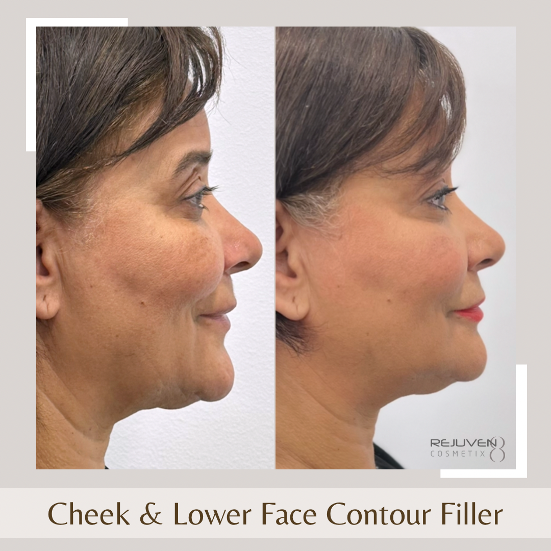 Facial Fillers - Cheeks & Lower Face3