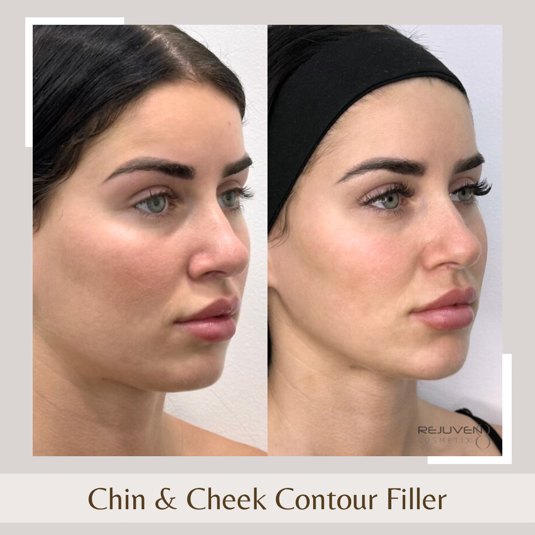 Facial Fillers- Chin & Cheeks
