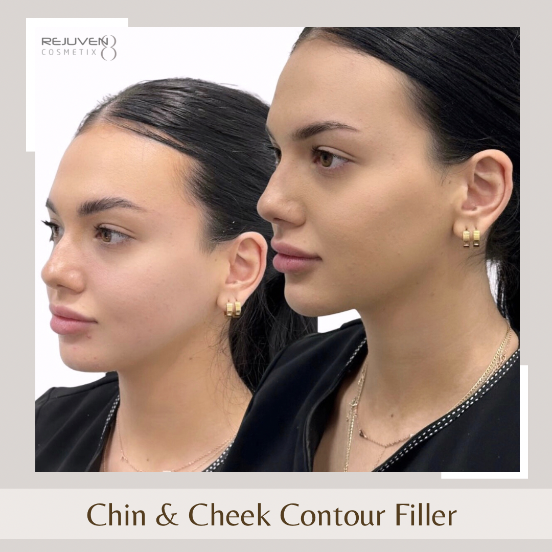 Facial Fillers- Chin & Cheeks2