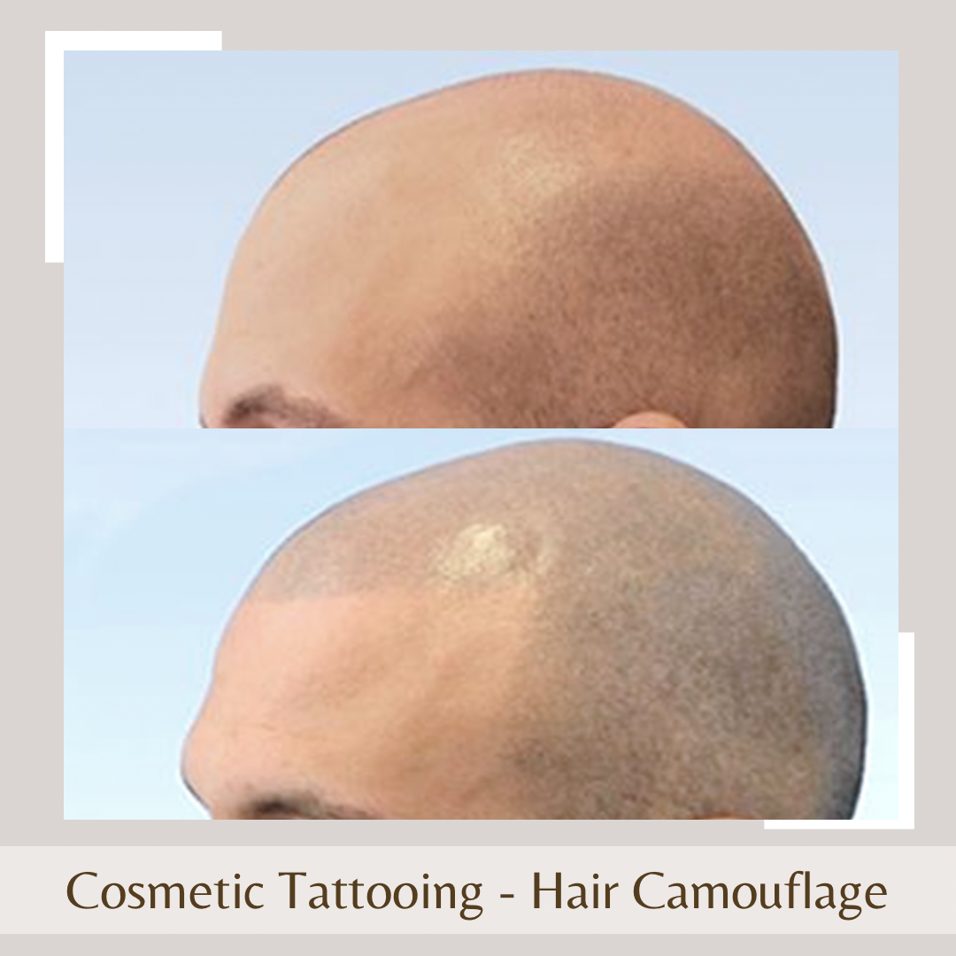 Cosmetic Tattoo - Hair camoufl