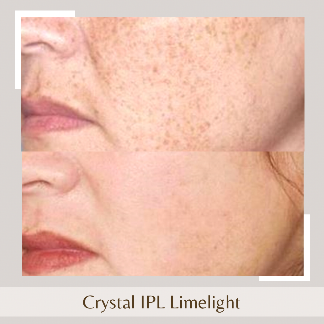 Crystal IPL Limelight1