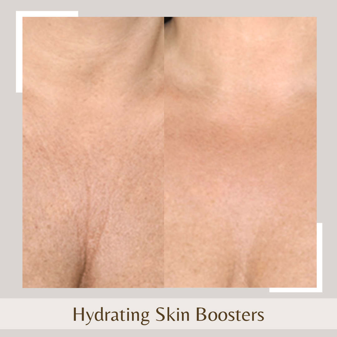 Hydrating Skin Boosters2png