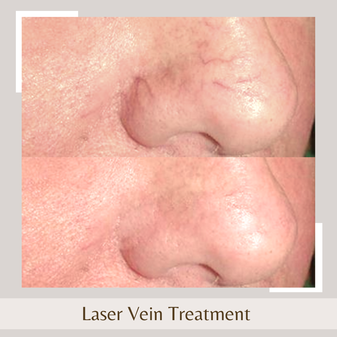 Laser Vein Treatment1