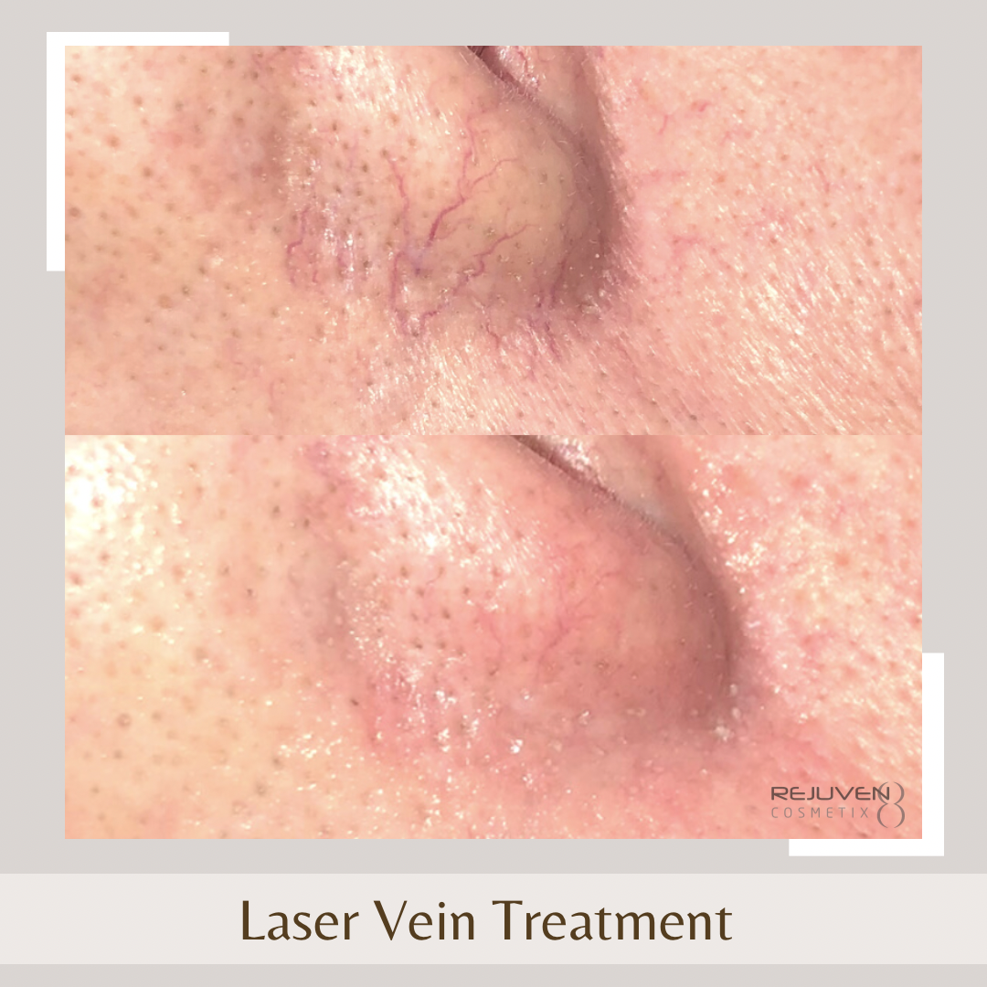 Laser Vein1 nose
