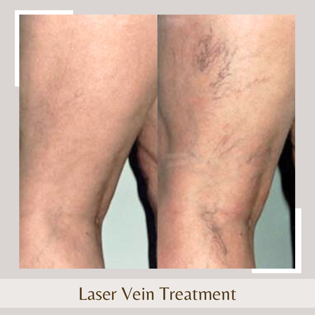 Laser Vein2 leg