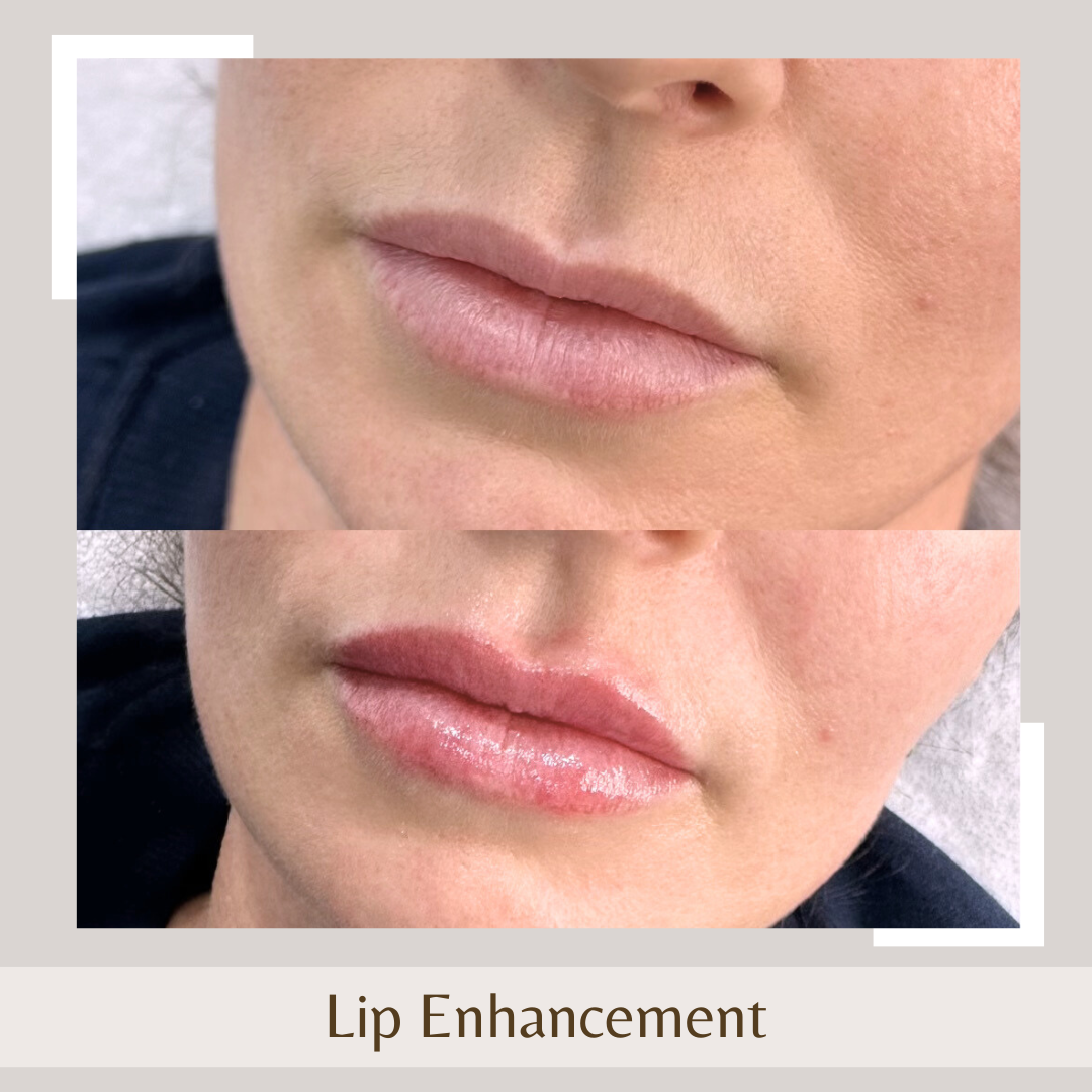 Lip Enhancement1