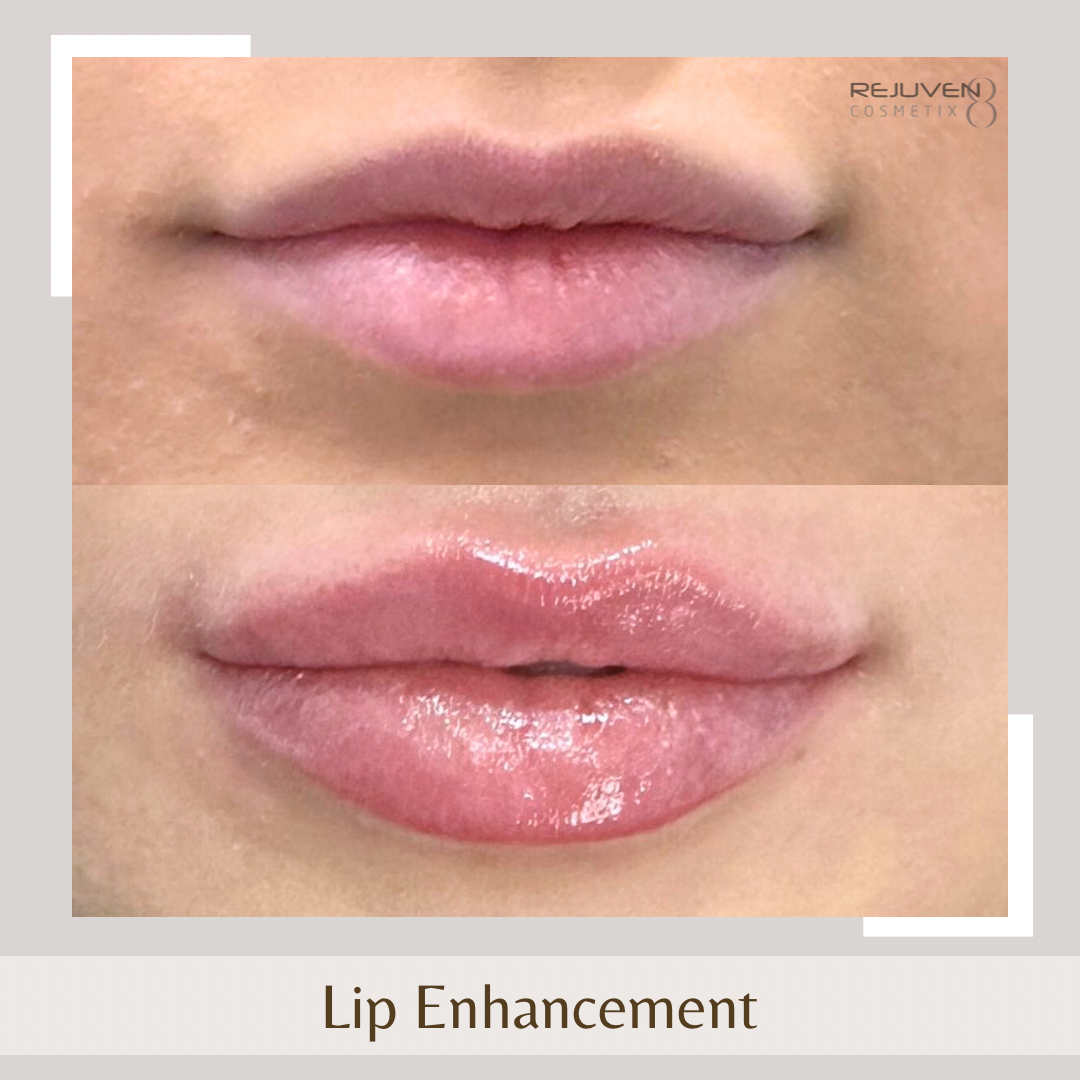 Lip Enhancement1