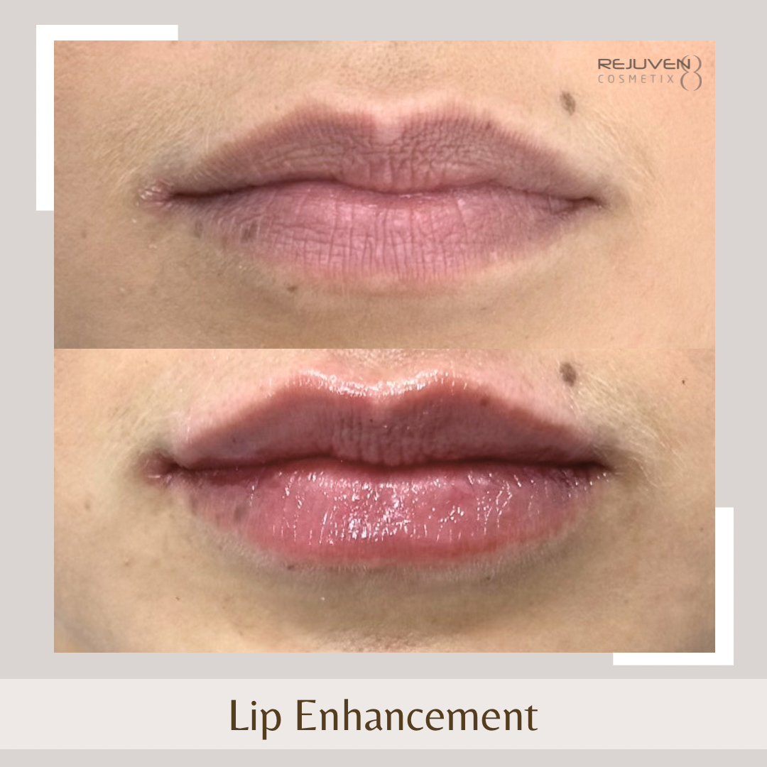 Lip Enhancement2
