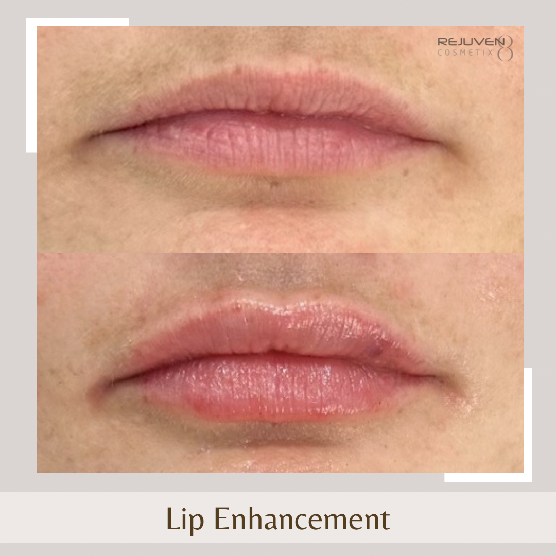 Lip Enhancement4