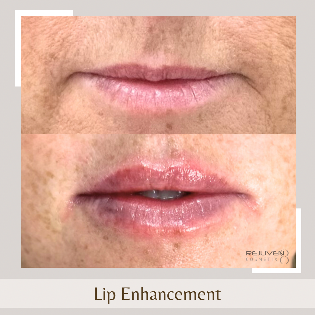 Lip Enhancement5