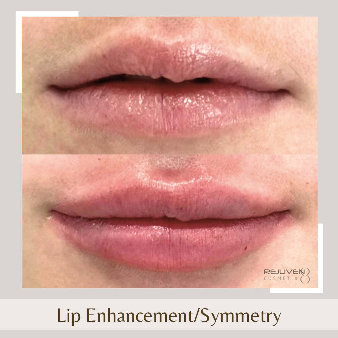 Lip Enhancement6 Lip fillers