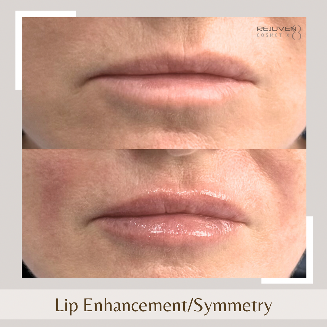 Lip fillers enhancement