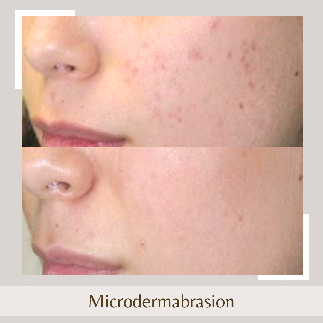 Microdermabrasion face