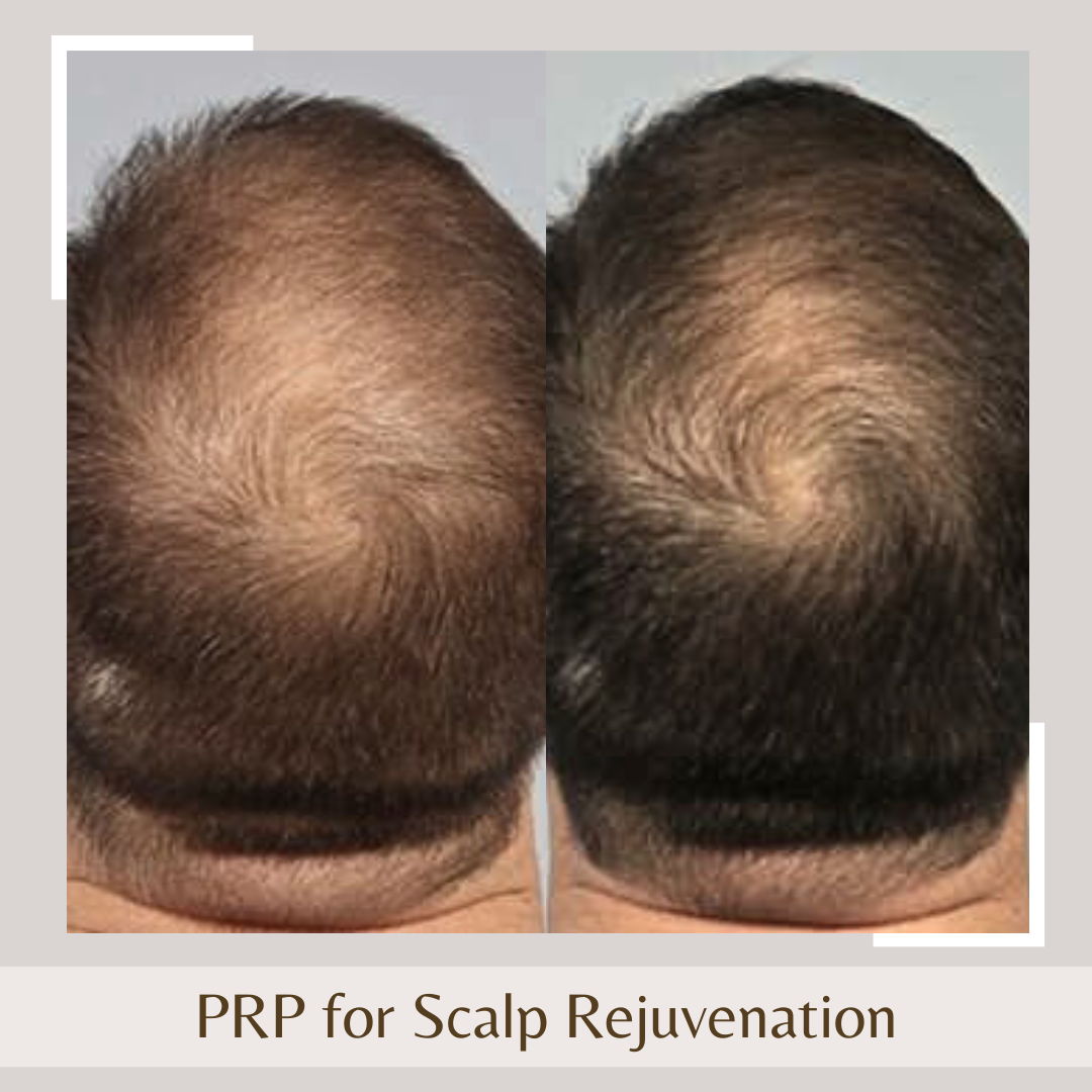 PRP For Scalp Rejuvenation
