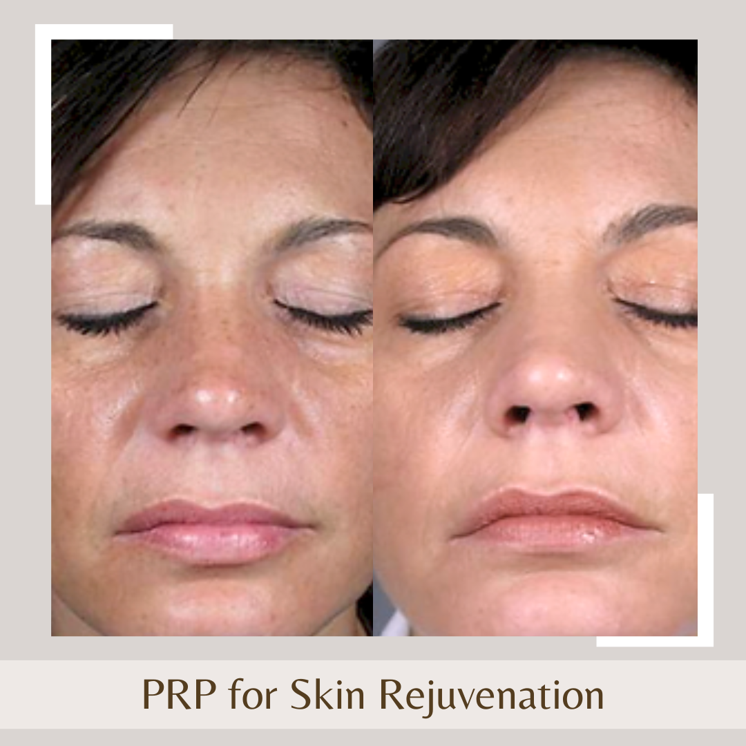 PRP for skin rejuvenation