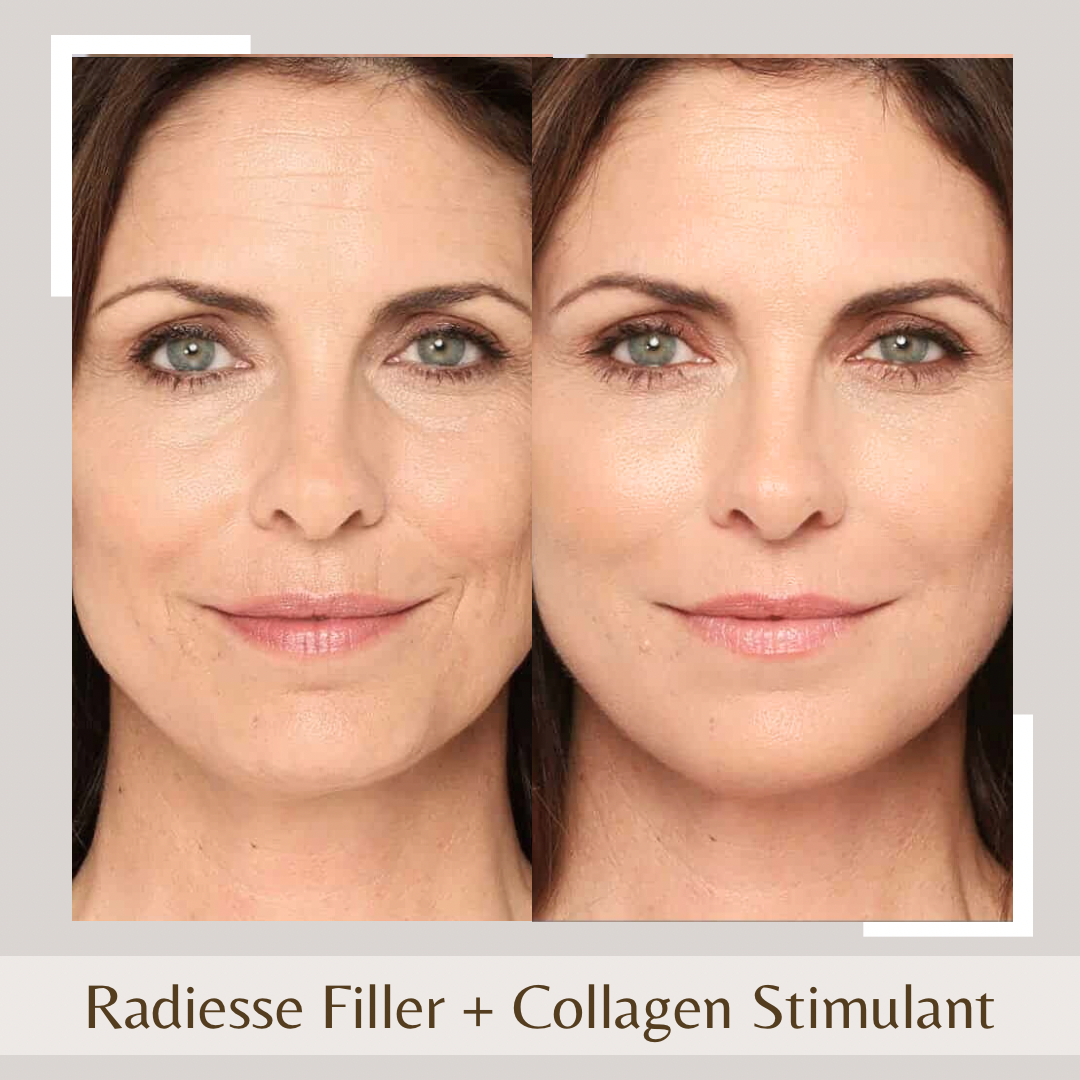 collagen stimulating injections