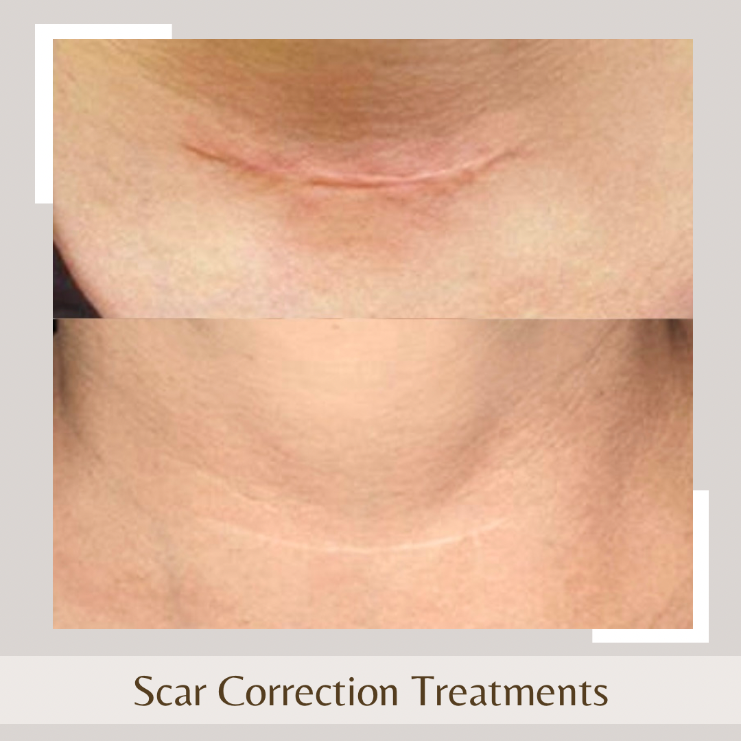 Scar Correction neck