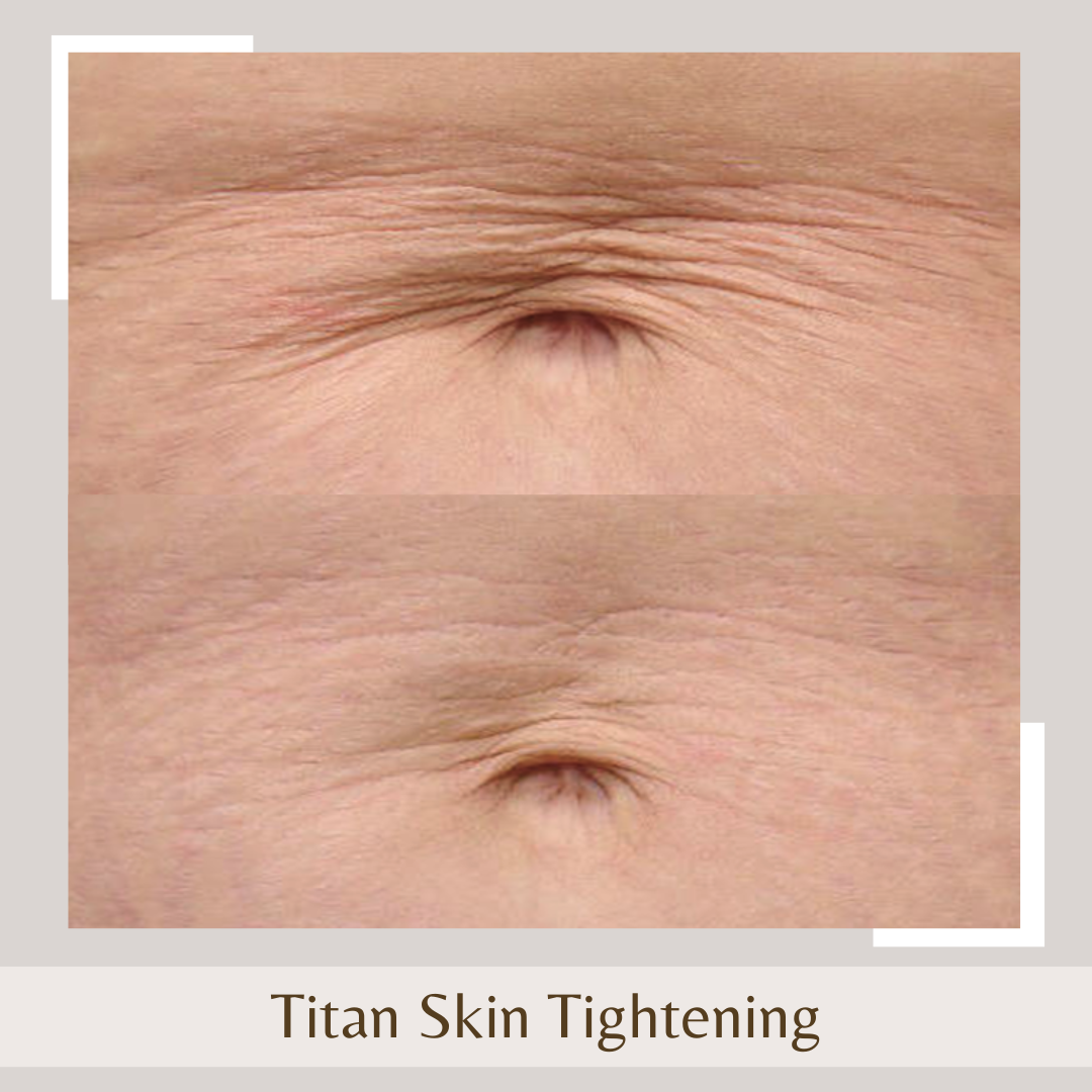 Titan Skin Tightening navel