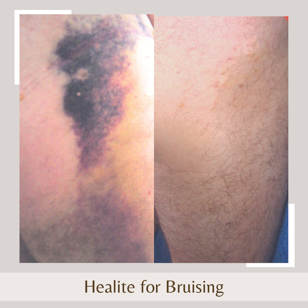 Healite3 bruise