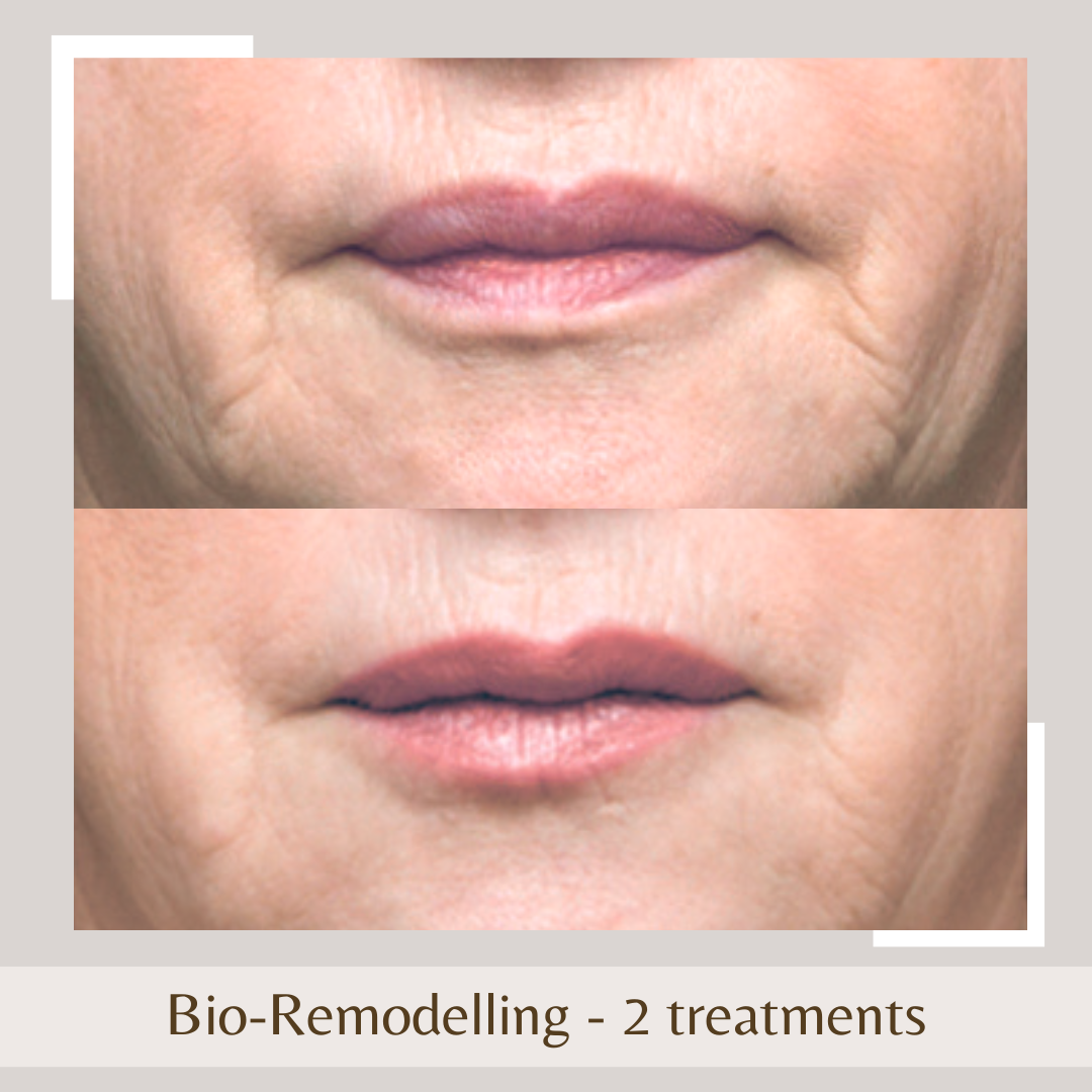 bio remodelling injections
