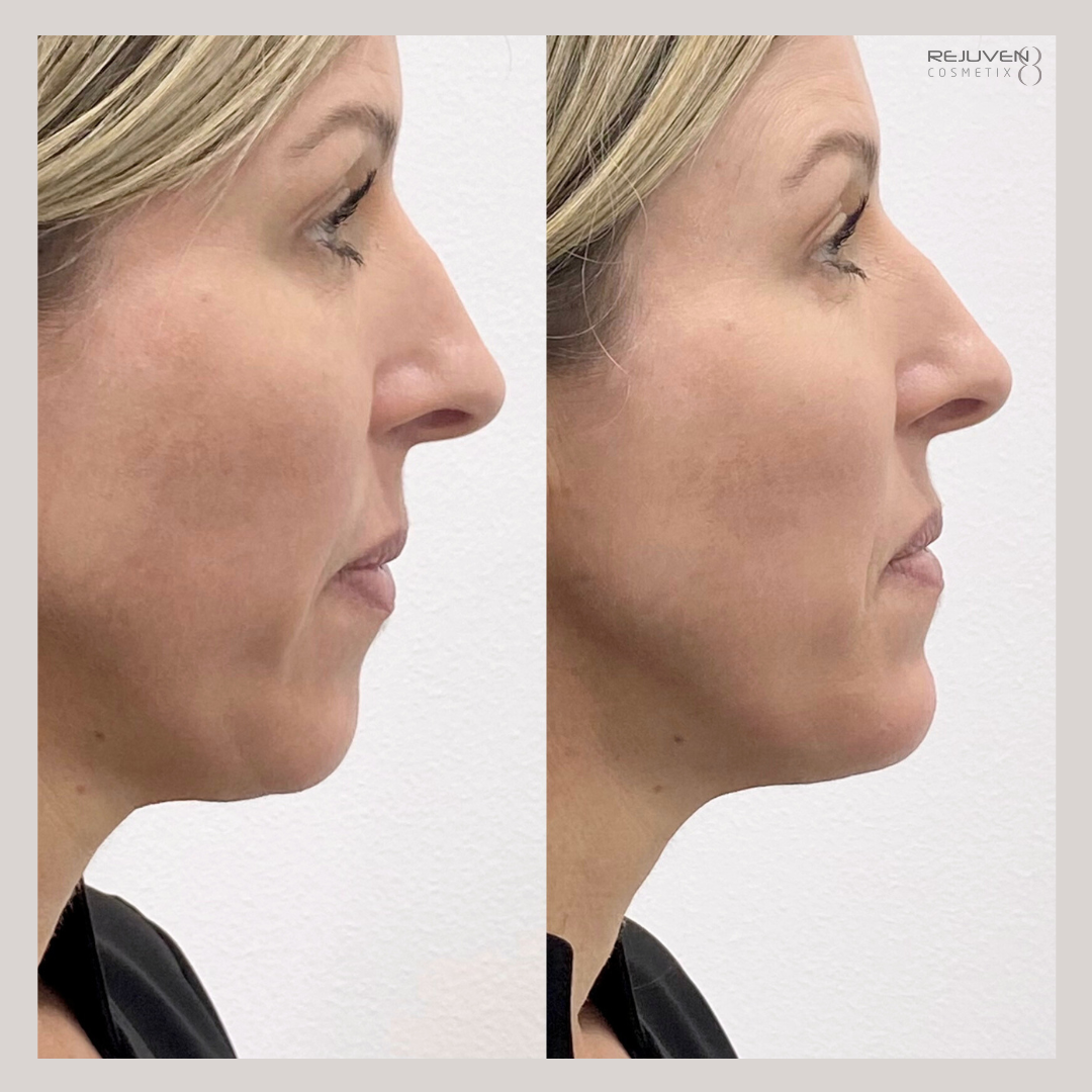 B&A Face Contouring Filler